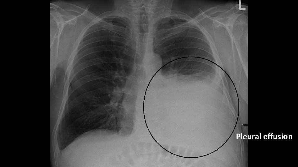 Pleural effusion 