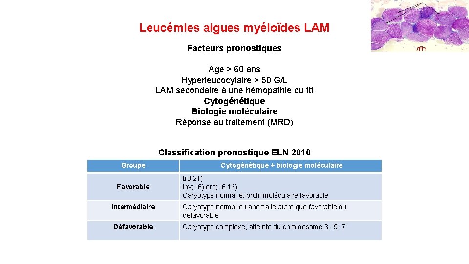 Leucémies aigues myéloïdes LAM Facteurs pronostiques Age > 60 ans Hyperleucocytaire > 50 G/L