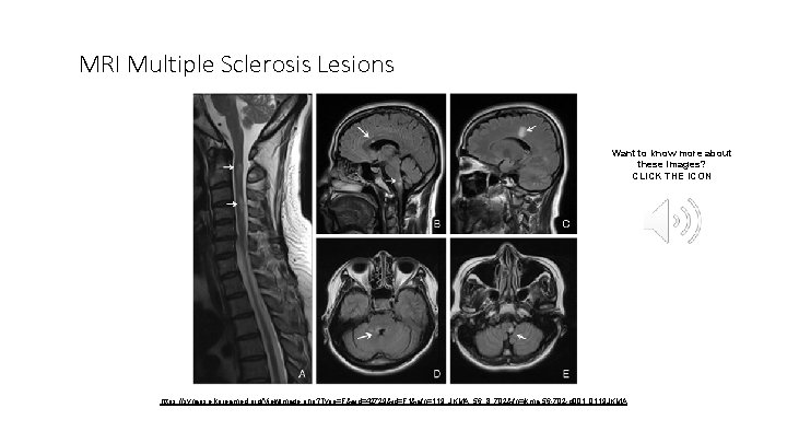 MRI Multiple Sclerosis Lesions Want to know more about these images? CLICK THE ICON