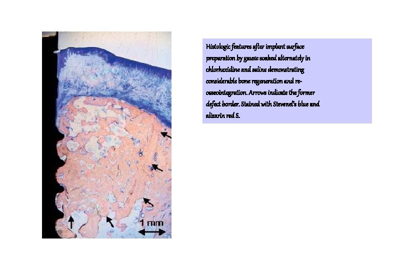 Histologic features after implant surface preparation by gauze soaked alternately in chlorhexidine and saline Histologic features after implant surface preparation by gauze soaked alternately in chlorhexidine and saline