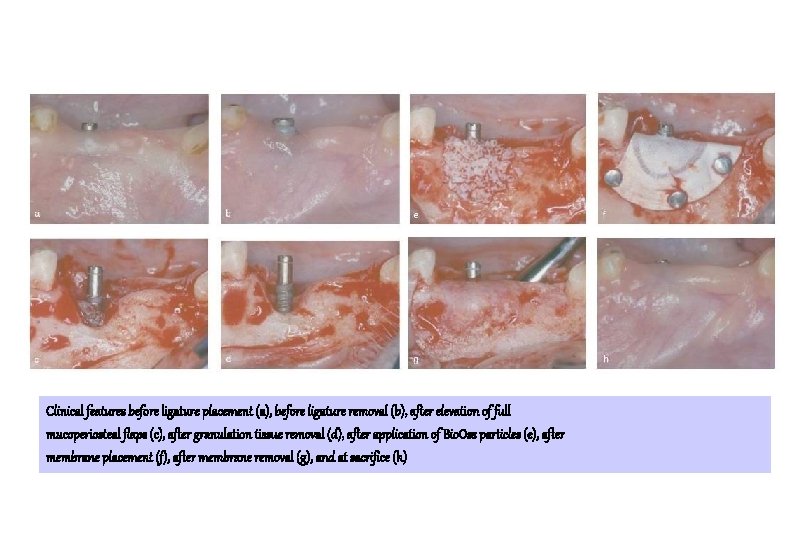Clinical features before ligature placement (a), before ligature removal (b), after elevation of full Clinical features before ligature placement (a), before ligature removal (b), after elevation of full