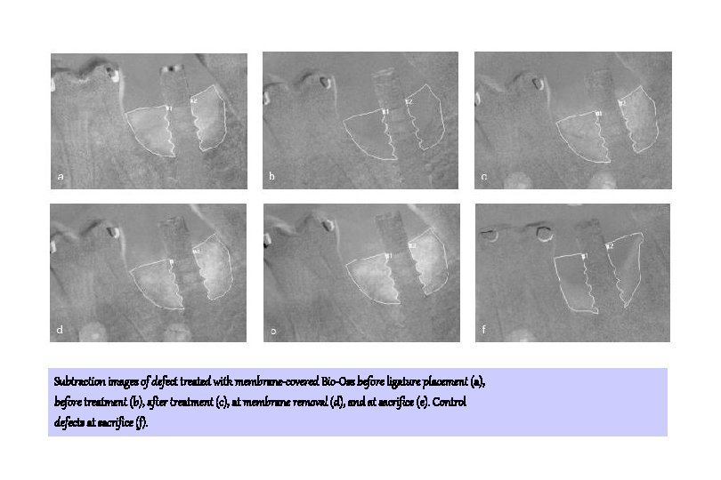 Subtraction images of defect treated with membrane-covered Bio-Oss before ligature placement (a), before treatment Subtraction images of defect treated with membrane-covered Bio-Oss before ligature placement (a), before treatment