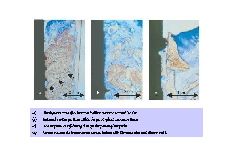 (a) (b) (c) (d) Histologic features after treatment with membrane-covered Bio-Oss Scattered Bio-Oss particles (a) (b) (c) (d) Histologic features after treatment with membrane-covered Bio-Oss Scattered Bio-Oss particles