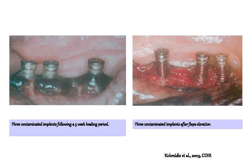 Three contaminated implants following a 5 week healing period. Three contaminated implants after flaps Three contaminated implants following a 5 week healing period. Three contaminated implants after flaps