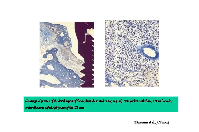 (a) Marginal portion of the distal aspect of the implant illustrated in Fig. 2 (a) Marginal portion of the distal aspect of the implant illustrated in Fig. 2