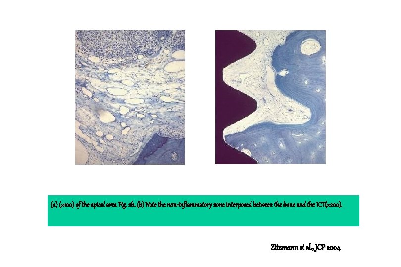 (a) (× 100) of the apical area Fig. 2 b. (b) Note the non-inflammatory (a) (× 100) of the apical area Fig. 2 b. (b) Note the non-inflammatory