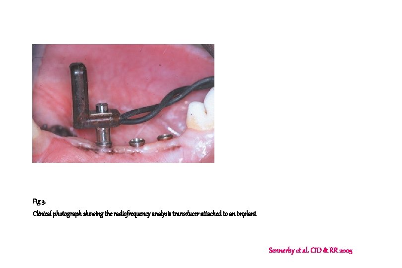 Fig 3. Clinical photograph showing the radiofrequency analysis transducer attached to an implant Sennerby Fig 3. Clinical photograph showing the radiofrequency analysis transducer attached to an implant Sennerby