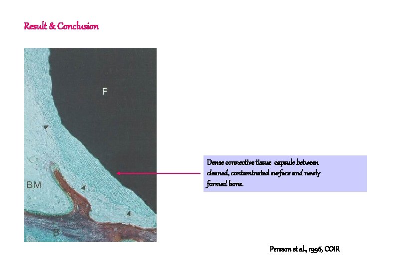 Result & Conclusion Dense connective tissue capsule between cleaned, contaminated surface and newly formed Result & Conclusion Dense connective tissue capsule between cleaned, contaminated surface and newly formed