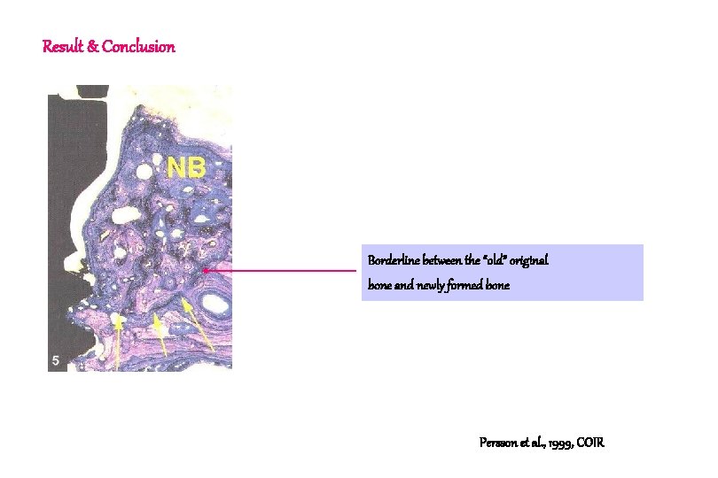 Result & Conclusion Borderline between the “old” original bone and newly formed bone Persson Result & Conclusion Borderline between the “old” original bone and newly formed bone Persson