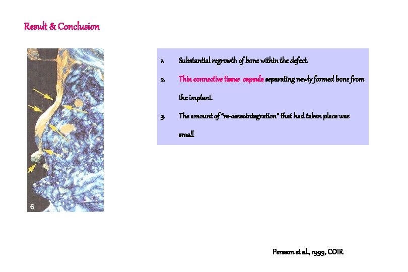 Result & Conclusion 1. Substantial regrowth of bone within the defect. 2. Thin connective Result & Conclusion 1. Substantial regrowth of bone within the defect. 2. Thin connective