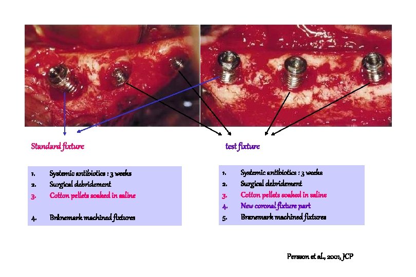 Standard fixture 1. 2. 3. Systemic antibiotics : 3 weeks Surgical debridement Cotton pellets Standard fixture 1. 2. 3. Systemic antibiotics : 3 weeks Surgical debridement Cotton pellets
