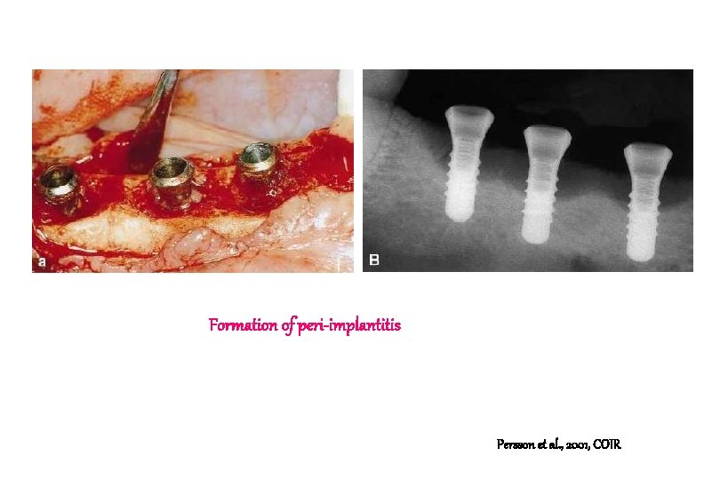 Formation of peri-implantitis Persson et al. , 2001, COIR Formation of peri-implantitis Persson et al. , 2001, COIR