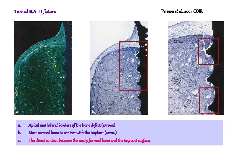 Turned SLA ITI fixture a. b. c. Apical and lateral borders of the bone Turned SLA ITI fixture a. b. c. Apical and lateral borders of the bone