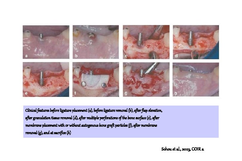 Clinical features before ligature placement (a), before ligature removal (b), after flap elevation, after Clinical features before ligature placement (a), before ligature removal (b), after flap elevation, after