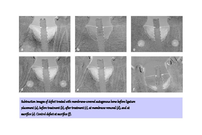 Subtraction images of defect treated with membrane-covered autogenous bone before ligature placement (a), before Subtraction images of defect treated with membrane-covered autogenous bone before ligature placement (a), before