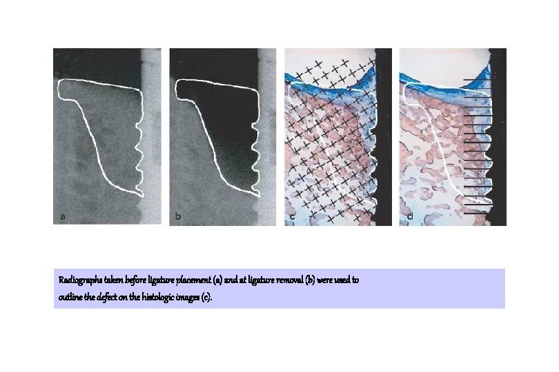 Radiographs taken before ligature placement (a) and at ligature removal (b) were used to Radiographs taken before ligature placement (a) and at ligature removal (b) were used to