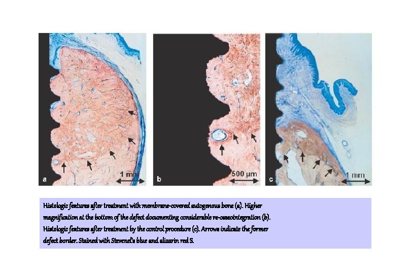 Histologic features after treatment with membrane-covered autogenous bone (a). Higher magnification at the bottom Histologic features after treatment with membrane-covered autogenous bone (a). Higher magnification at the bottom