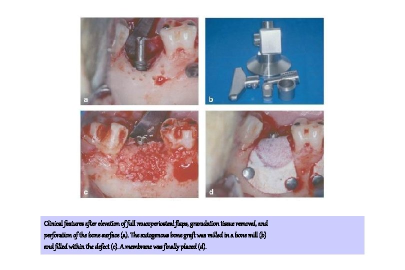 Clinical features after elevation of full mucoperiosteal flaps, granulation tissue removal, and perforation of Clinical features after elevation of full mucoperiosteal flaps, granulation tissue removal, and perforation of