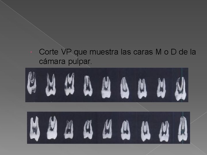 Corte VP que muestra las caras M o D de la cámara pulpar. Corte VP que muestra las caras M o D de la cámara pulpar.