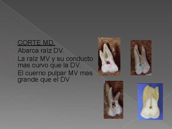 CORTE MD. Abarca raíz DV. La raíz MV y su conducto mas curvo que CORTE MD. Abarca raíz DV. La raíz MV y su conducto mas curvo que