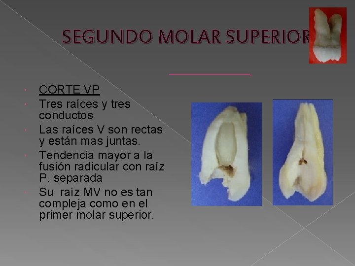 SEGUNDO MOLAR SUPERIOR CORTE VP Tres raíces y tres conductos Las raíces V son SEGUNDO MOLAR SUPERIOR CORTE VP Tres raíces y tres conductos Las raíces V son