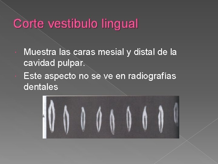 Corte vestibulo lingual Muestra las caras mesial y distal de la cavidad pulpar. Este Corte vestibulo lingual Muestra las caras mesial y distal de la cavidad pulpar. Este