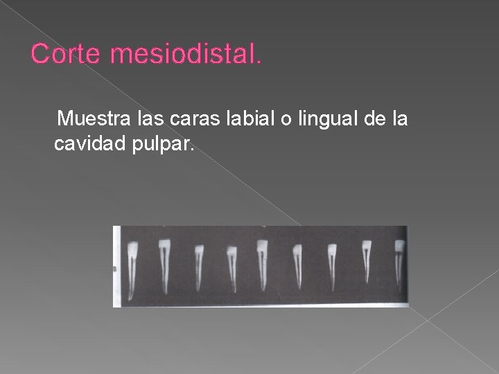 Corte mesiodistal. Muestra las caras labial o lingual de la cavidad pulpar. Corte mesiodistal. Muestra las caras labial o lingual de la cavidad pulpar.