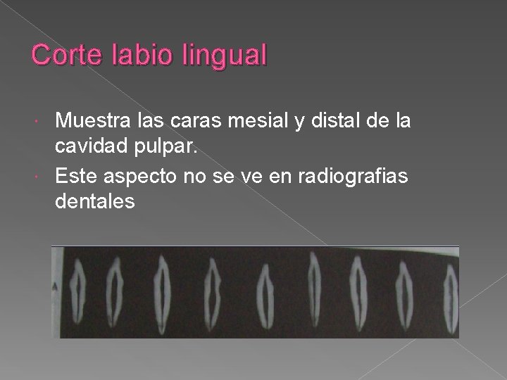 Corte labio lingual Muestra las caras mesial y distal de la cavidad pulpar. Este Corte labio lingual Muestra las caras mesial y distal de la cavidad pulpar. Este