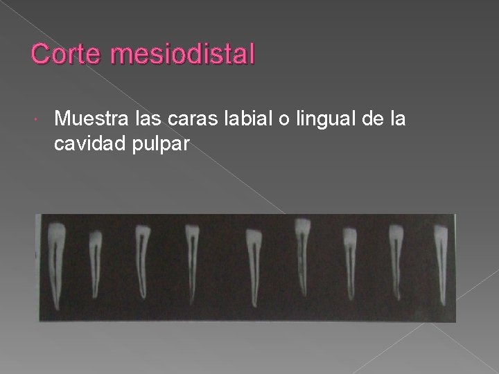 Corte mesiodistal Muestra las caras labial o lingual de la cavidad pulpar Corte mesiodistal Muestra las caras labial o lingual de la cavidad pulpar