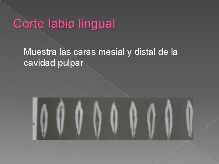Corte labio lingual Muestra las caras mesial y distal de la cavidad pulpar Corte labio lingual Muestra las caras mesial y distal de la cavidad pulpar