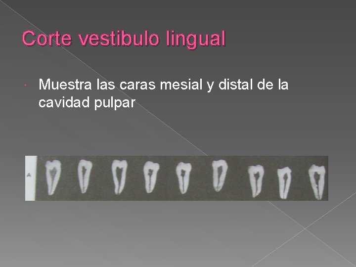 Corte vestibulo lingual Muestra las caras mesial y distal de la cavidad pulpar Corte vestibulo lingual Muestra las caras mesial y distal de la cavidad pulpar