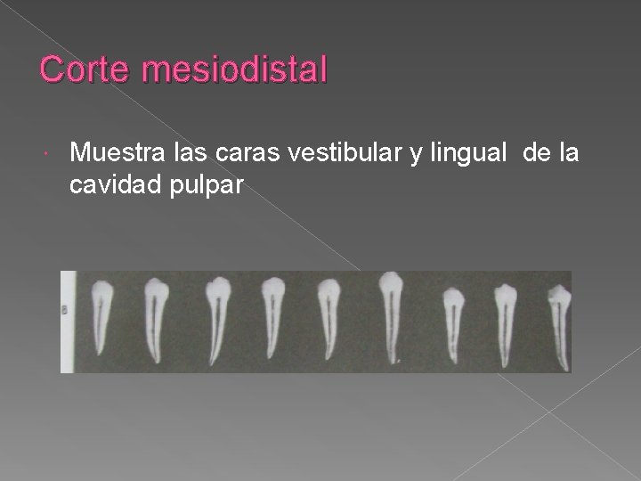 Corte mesiodistal Muestra las caras vestibular y lingual de la cavidad pulpar Corte mesiodistal Muestra las caras vestibular y lingual de la cavidad pulpar