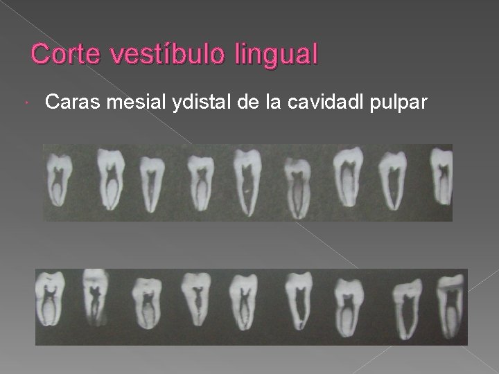 Corte vestíbulo lingual Caras mesial ydistal de la cavidadl pulpar Corte vestíbulo lingual Caras mesial ydistal de la cavidadl pulpar