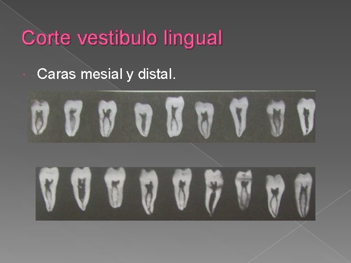 Corte vestibulo lingual Caras mesial y distal. Corte vestibulo lingual Caras mesial y distal.