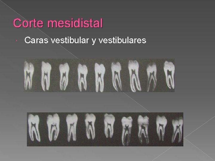 Corte mesidistal Caras vestibular y vestibulares Corte mesidistal Caras vestibular y vestibulares