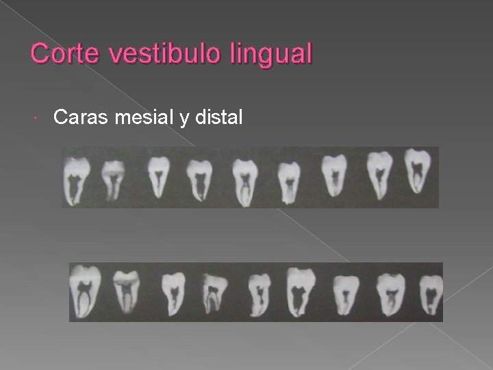 Corte vestibulo lingual Caras mesial y distal Corte vestibulo lingual Caras mesial y distal