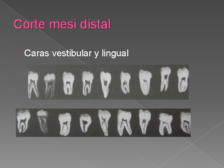 Corte mesi distal Caras vestibular y lingual Corte mesi distal Caras vestibular y lingual