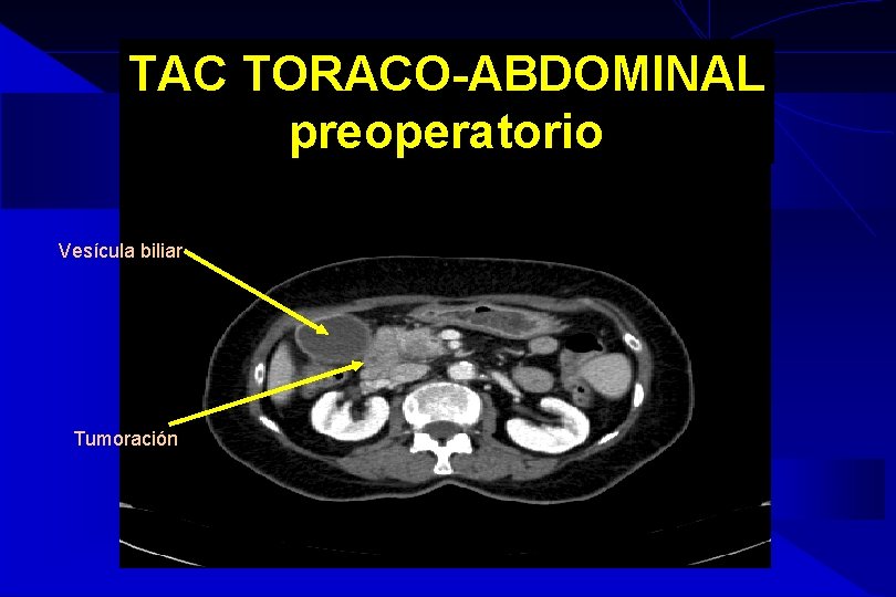 TAC TORACO-ABDOMINAL preoperatorio Vesícula biliar Tumoración TAC TORACO-ABDOMINAL preoperatorio Vesícula biliar Tumoración
