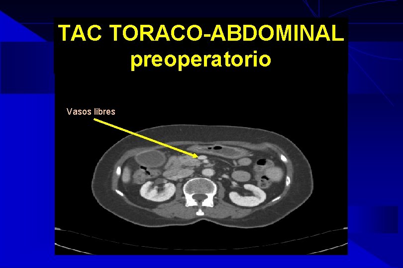 TAC TORACO-ABDOMINAL preoperatorio Vasos libres TAC TORACO-ABDOMINAL preoperatorio Vasos libres