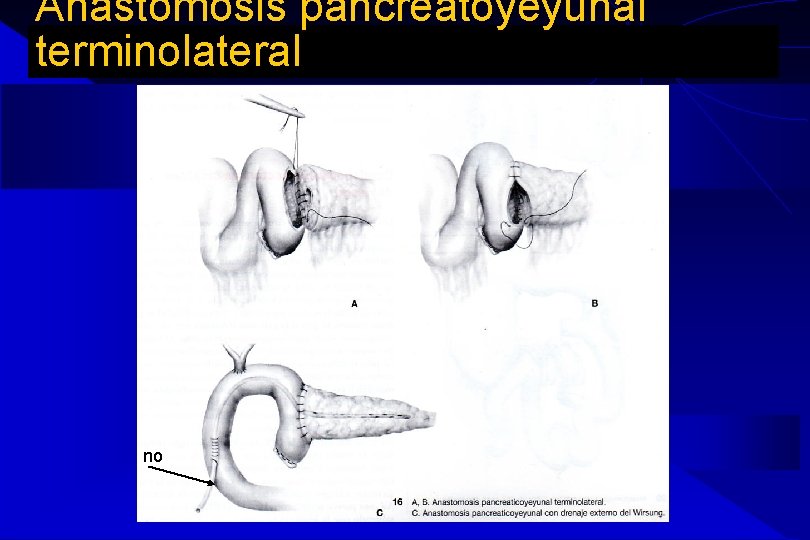 Anastomosis pancreatoyeyunal terminolateral no Anastomosis pancreatoyeyunal terminolateral no