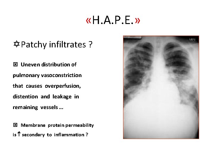  «H. A. P. E. » Y Patchy infiltrates ? ý Uneven distribution of