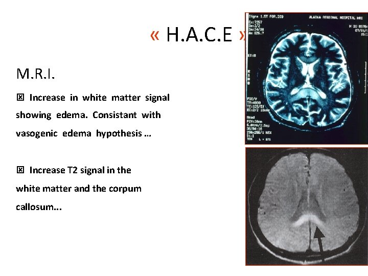  « H. A. C. E » M. R. I. ý Increase in white