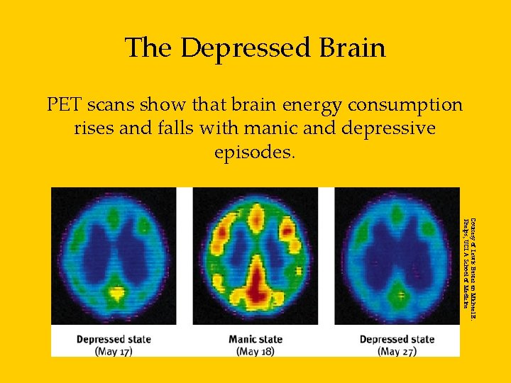 The Depressed Brain PET scans show that brain energy consumption rises and falls with