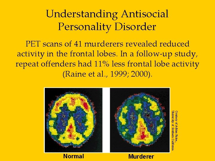 Understanding Antisocial Personality Disorder PET scans of 41 murderers revealed reduced activity in the