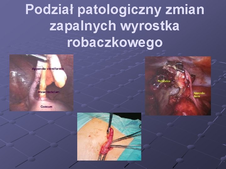 Podział patologiczny zmian zapalnych wyrostka robaczkowego 