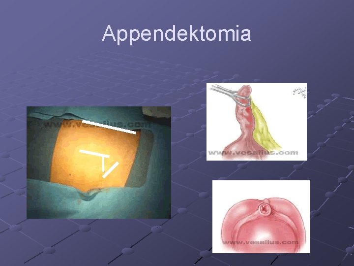 Appendektomia 