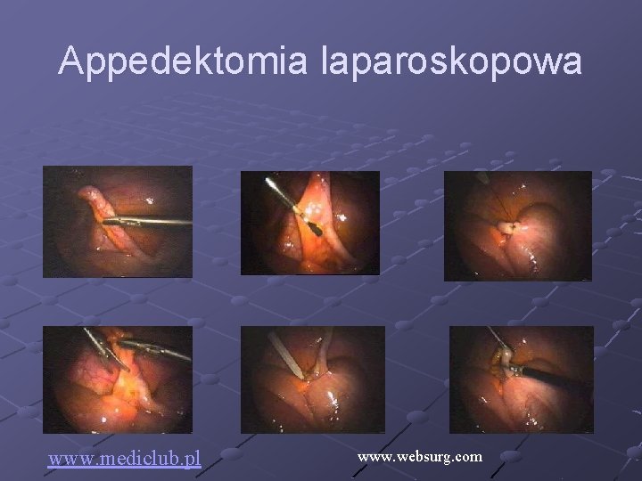 Appedektomia laparoskopowa www. mediclub. pl www. websurg. com 