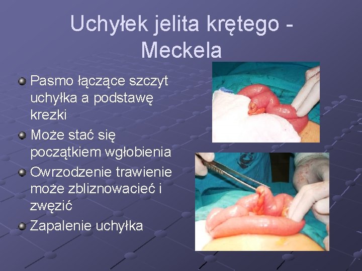 Uchyłek jelita krętego Meckela Pasmo łączące szczyt uchyłka a podstawę krezki Może stać się