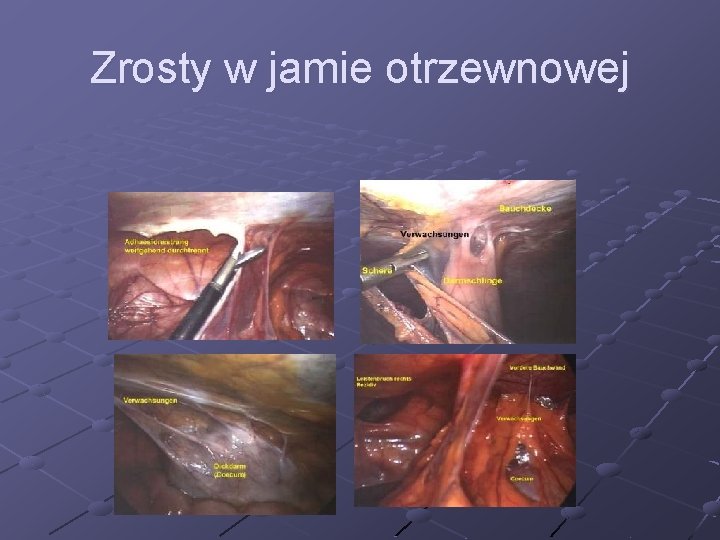 Zrosty w jamie otrzewnowej 