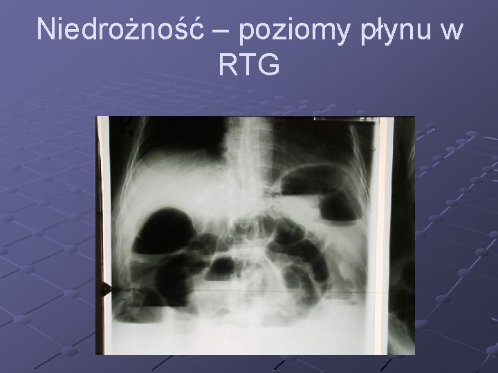 Niedrożność – poziomy płynu w RTG 